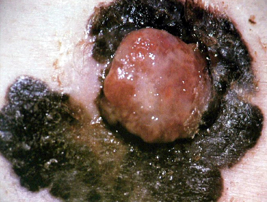 Nodular melanoma